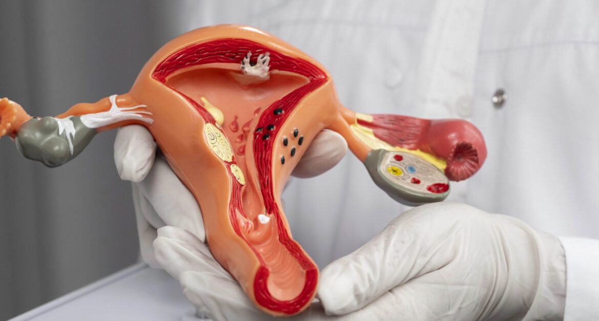 Mengenal Kanker Endometrium, Kenali Gejala dan Pengobatannya
