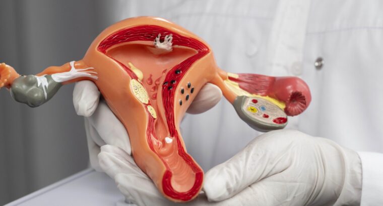Mengenal Kanker Endometrium, Kenali Gejala dan Pengobatannya