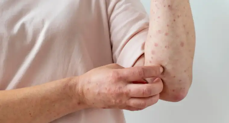 Mengenal Lebih Dekat Flu Singapura: Gejala, Penyebab, dan Pencegahannya